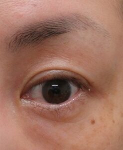左上眼瞼のまつ毛のホクロの切除。1ヶ月目。
