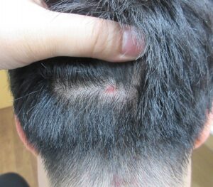 後頭部の1センチ越えのホクロの剥ぎ取り法による切除。2ヶ月目の経過。