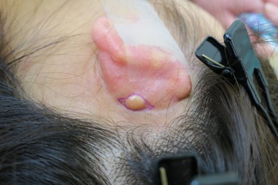 豊洲で耳の粉瘤を切除。1週間目の傷。
