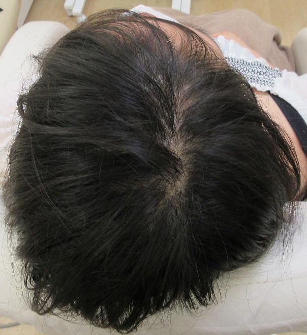 豊洲で女性の薄毛治療。２０代前半女性。メソセラピー５か月目の経過。