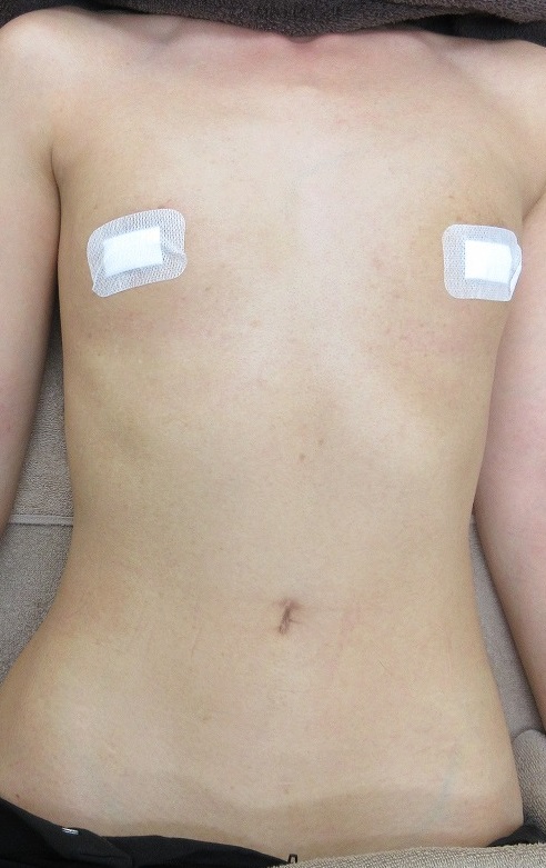 30代女性。バスト周り・腹部のイボのレーザー取り放題治療の様子。1カ月半目の経過。