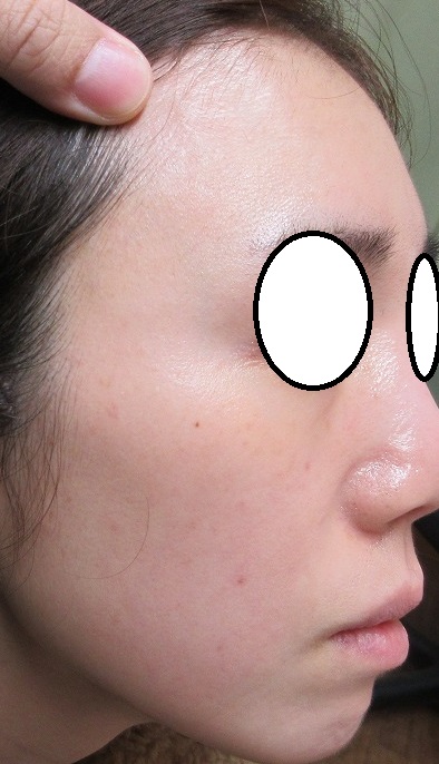 30代女性。顔のイボのレーザー取り放題治療＋ゼオスキン・セラピューティックプログラム。4ヶ月目。