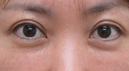 40代女性。クマの手術の3年3ヶ月目の経過＋上眼瞼たるみとり（眉下切開法）1年目の経過。