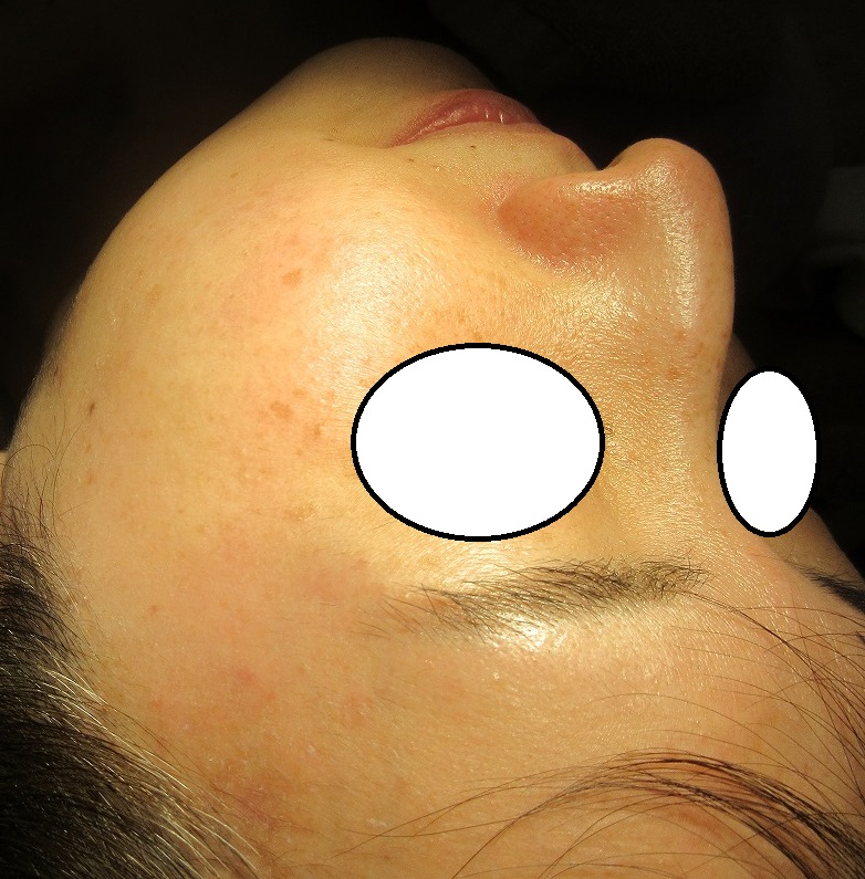 顔と首の大量のイボのレーザー取り放置治療。2カ月目の経過。