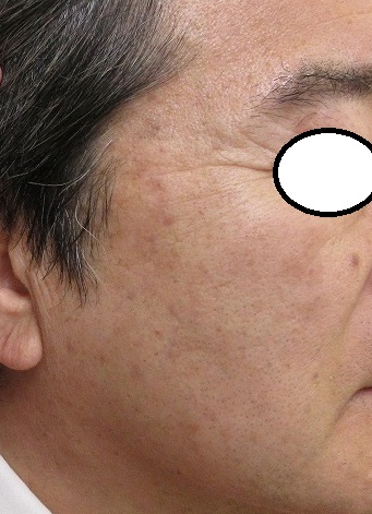 60代後半男性。顔のイボとしみの同時治療。2カ月目の経過。