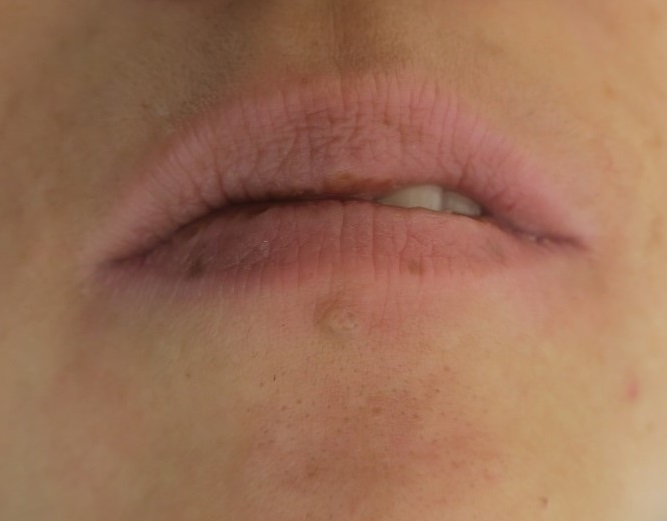 唇の下の皮膚にある隆起性のホクロを切除しました。2か月後の経過。