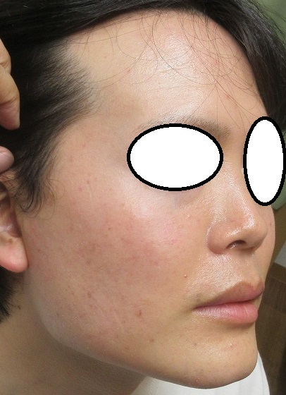 １年間で顔のホクロのレーザー治療を４回施行。最後から６か月経過の状態。
