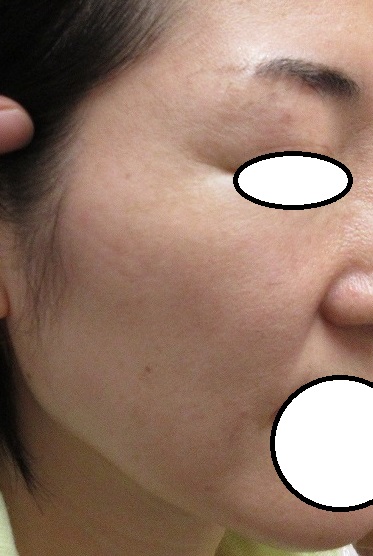 上眼瞼 頬 口周りの多発するシミのレーザー治療 ２週目の経過 豊洲佐藤クリニック