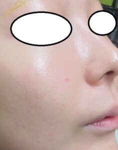 右頬のホクロ様のできもの（線維性丘疹）の切除。2年目の経過（2週目、2カ月目もあり）。