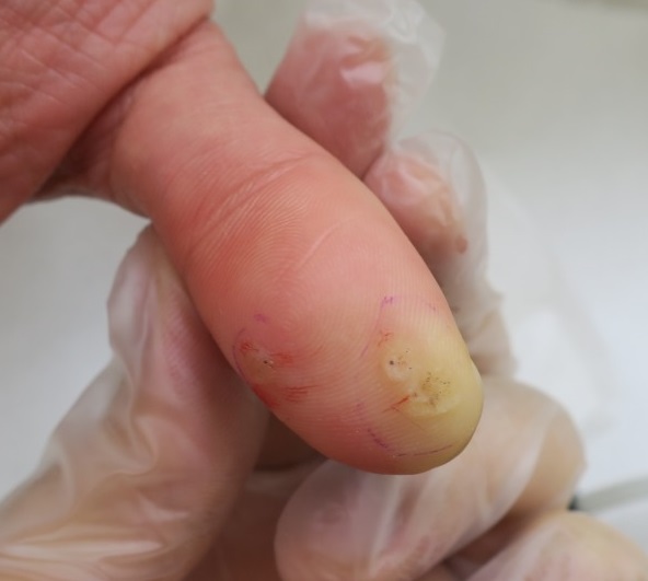 豊洲で手の親指のイボを切除。ウイルス性のイボの正体はこんな感じで分厚いのです。
