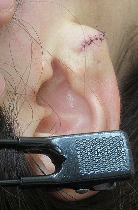 ピアストラブルによる耳垂裂の手術。手術直後の状態。