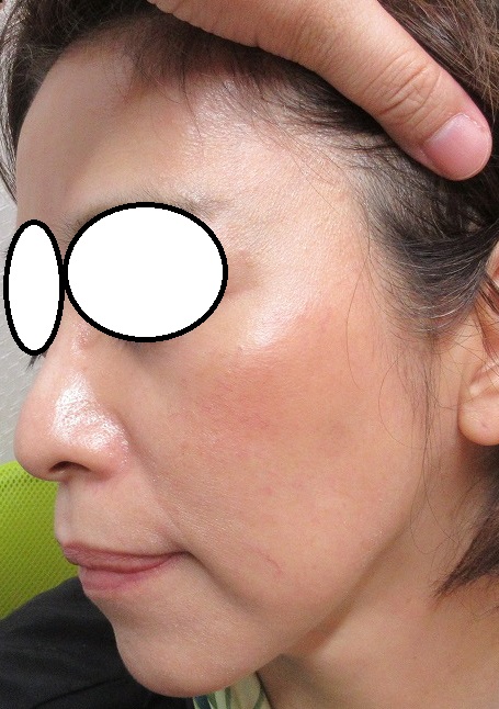 55歳女性。顔首の大量のイボの治療の経過。10ヶ月目。