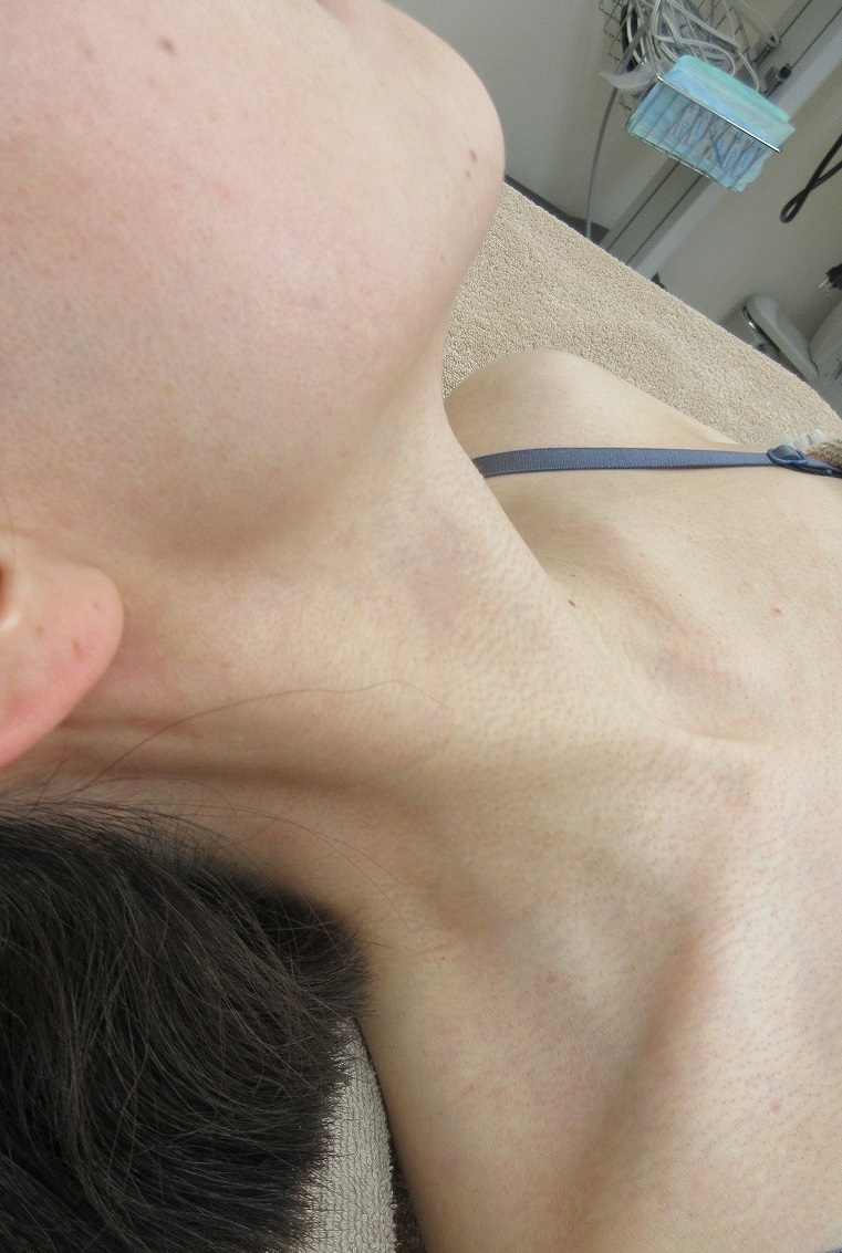 首からフェイスラインにかけてのイボのレーザー治療。3か月目の経過。