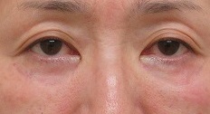 57歳女性。目の下のクマの手術（経結膜的脱脂＋脂肪注入＋ヒアルロン酸）。直後の状態。