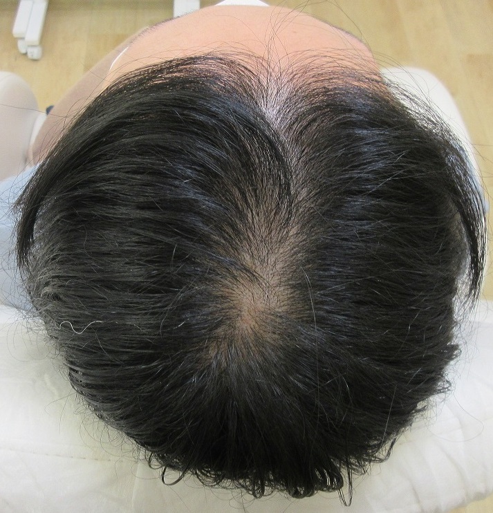 女性の薄毛治療。AGF３９によるメソセラピー治療の経過。