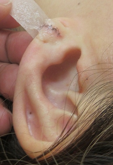 ピアストラブルによる耳垂裂の手術。直後の状態。