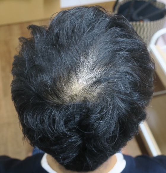 豊洲で薄毛（AGA)治療。3年目。頭部全体の薄毛がかなり改善しています。