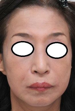 60代女性。定期的な治療で美を保つ。ヒアルロン酸注入直後の状態。