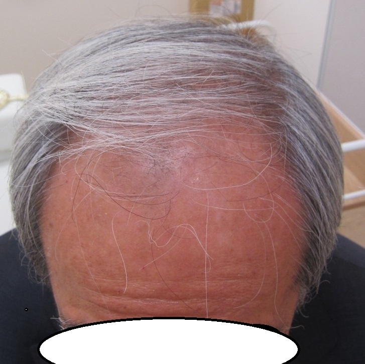 豊洲で薄毛（AGA)治療。2年10か月目。当院最高齢74歳。ここまで改善。