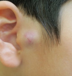 耳の近くのシコリを切除しました。2週間目の傷。この段階ですでに傷が目立たなくなりましたね。