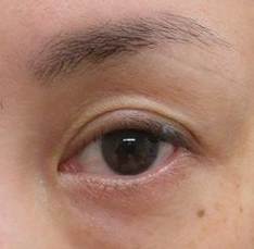 まつ毛の生え際のほくろ