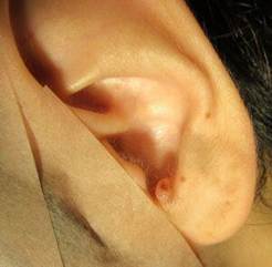 ケロイド好発部位（耳・肩甲骨・デコルテなど）