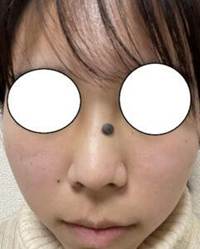 鼻筋のほくろ・他院修正