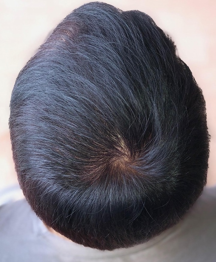 50代男性の薄毛(AGA)治療。ドットヘア内服外用。6年9か月目の経過。