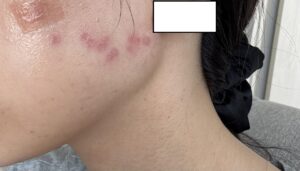 スキャナー付きCO2レーザーのトラブル。スキャナー付きＣＯ２レーザーに慣れてないドクターはイボ治療をするな！当院で治療した部分とスキャナー付きCO2レーザーでやった部分の治りの差。